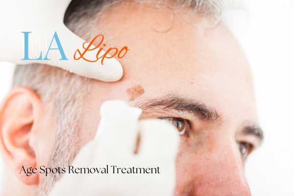 What Are the Most Effective Treatments for Age Spots Burley?