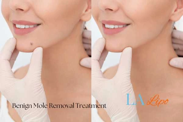 woman's before and after mole removal Burley results