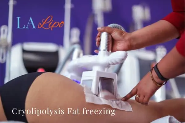 women getting fat freezing Burley