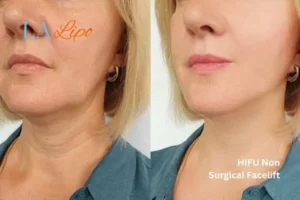 hi-fu for wrinkles Burley before and after results