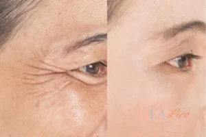 Before and after results of woman - HI-fu wrinkles reduction treatment Burley