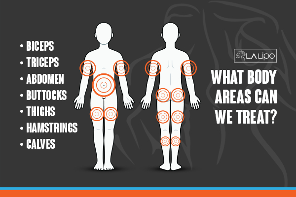 Graphic to show areas you can have LA-EMS Body Sculpting Burley treatment.