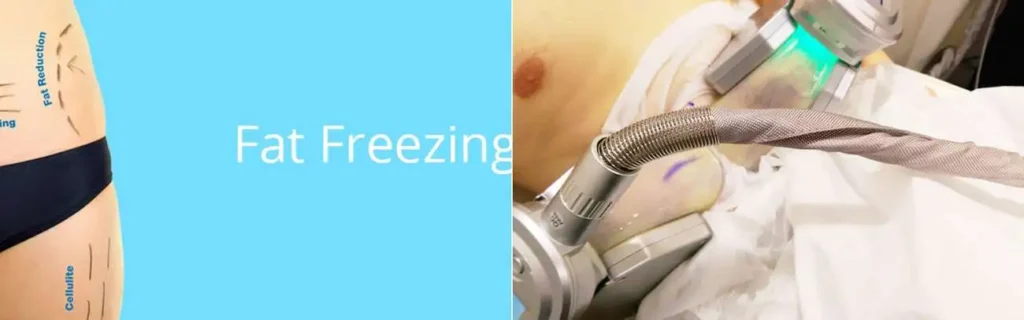 Fat freezing Burley on multiple areas of the body