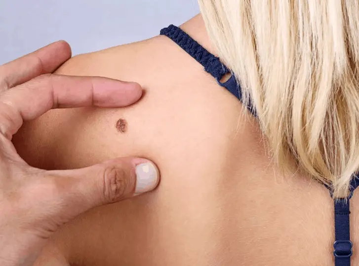woman having mole removal Burley consultation before treatment.