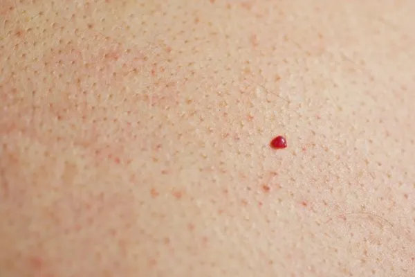 close up of a cherry angioma Burley