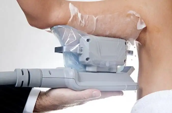 Picture of fat freezing Burley on the upper arms.