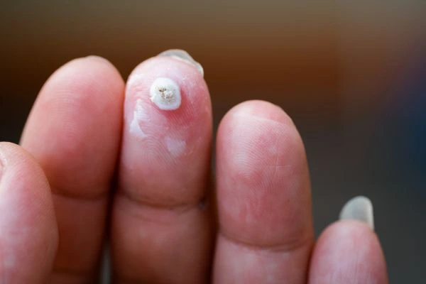 wart on person finger - cryotherapy to treat from LA LIPO Burley