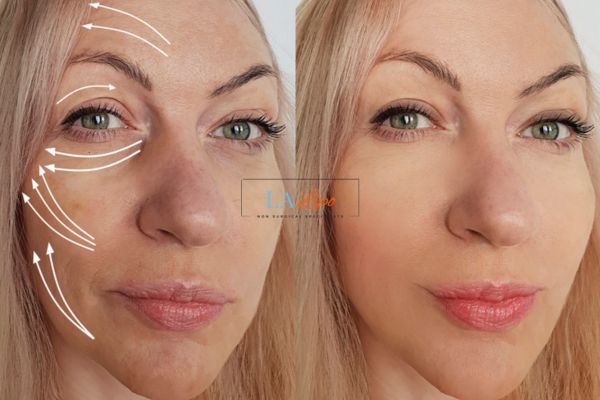Morpheus 8 results Burley face lift.