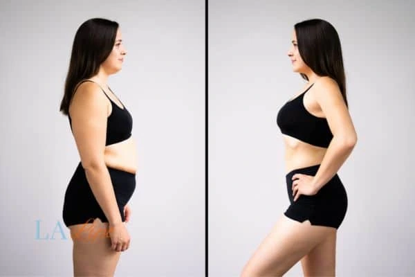 Picture of womans before and after using LA-EMS body sculpting to improve her core strength Burley