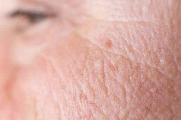 close up picture of a woman's face showing an age spot Burley