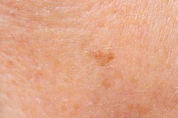 close up picture of age spots Burley
