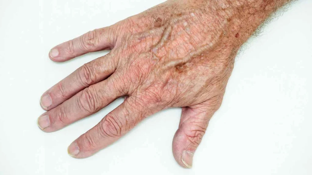 Male hand showing age spot Burley
