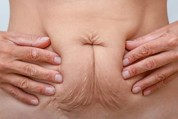 Should I Combine Diastasis Recti Treatment with Body Contouring for Better Results Burley?