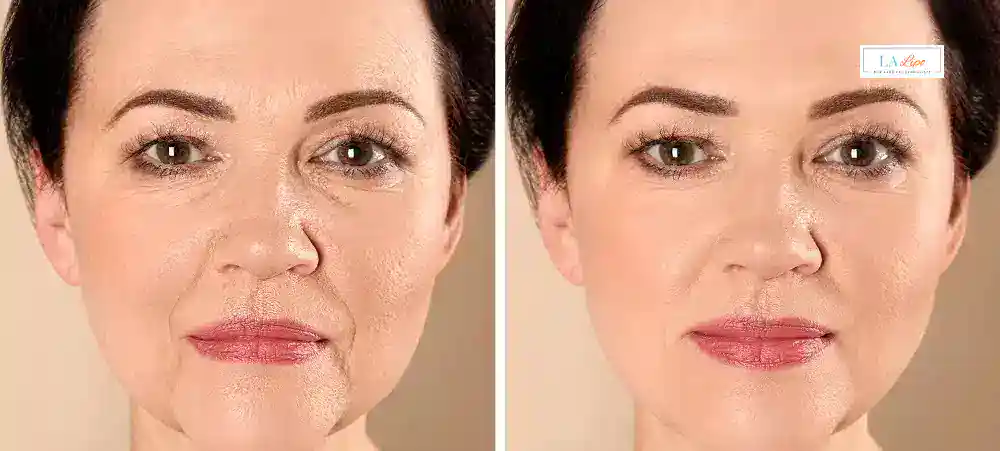How Long Does It Take to See Results and How Long Do They Last Burley?