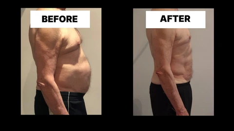 What Symptoms Can Diastasis Recti Cause in Men? Weak Core, Back Pain and Poor Posture Burley